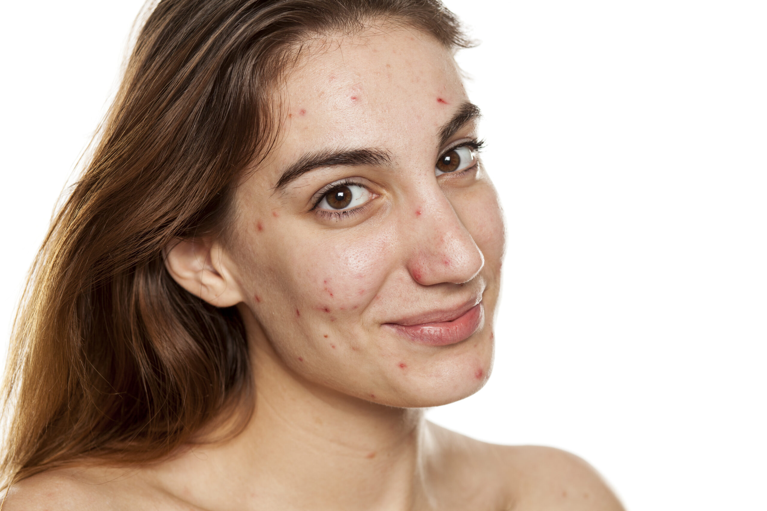 acne-tarda-behandeling