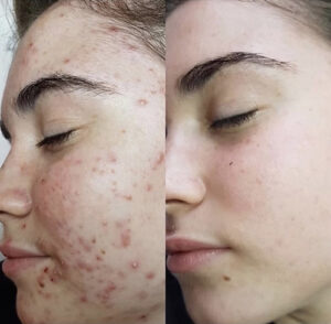 acne-behandeling