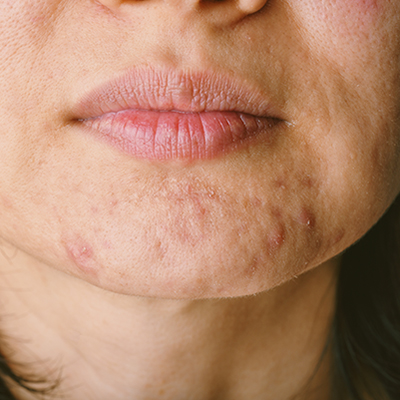 acne-littekens-behandeling