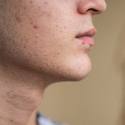 jeugdpuistjes-acne-behandeling