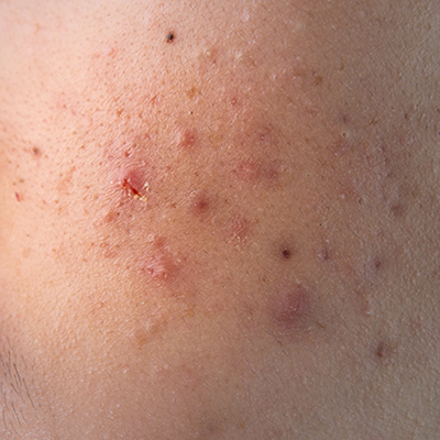 acne-tarda-volwassenen-acne